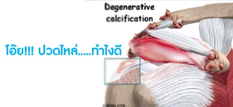 โอ๊ย!!! ปวดไหล่…..ทำไงดี
