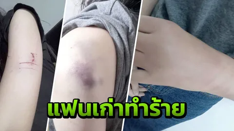 สาวแจ้งความ อ้างอดีตแฟนหนุ่มทำร้ายหลังบอกเลิก ใบหน้าบวม-ร่างกายบอบช้ำ