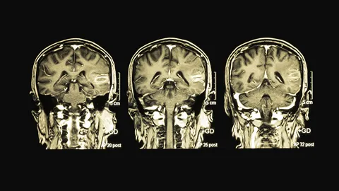 แพทย์ชี้พฤติกรรมร้ายทำเกิด “ภาวะสมองฝ่อ”