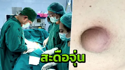 หมอเตือน "คนสะดือจุ่น" อย่าชะล่าใจ เสี่ยงลำไส้อุดตัน อันตรายถึงชีวิต