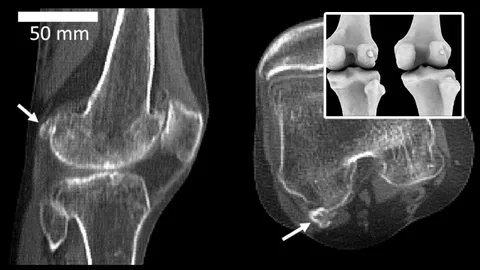 กระดูกที่เคยคิดว่าหายไปจากวิวัฒนาการมนุษย์