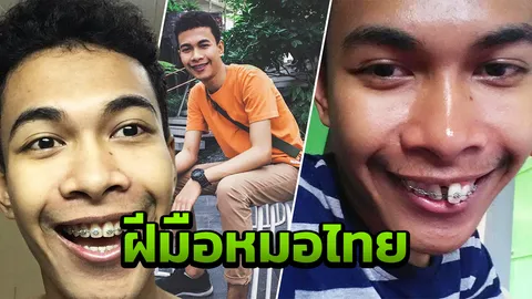 ดูดีที่สุดเลย หนุ่มโชว์วิวัฒนาการจัดฟันแค่ 2 ปี เปลี่ยนไปเหมือนคนละคน