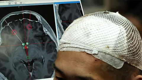 ใช้วิธีผ่าตัดสมองส่วนลึกช่วยผู้ติดยาเสพติด