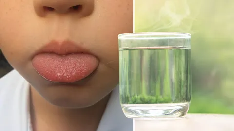 แม่อ้างลูกสาว 7 ขวบถูกเพื่อนให้ดื่มน้ำร้อนจนลิ้นพอง เผยโดนแกล้งนานนับปี