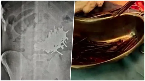 ชายอินเดียหวิดดับ ติดนิสัย “กินตะปู” ผ่ากระเพาะเจอกว่า 100 ตัว