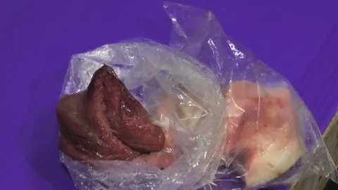 แพทย์เผย พบ 8 ชาวบ้านน่าน เปิบหมูดิบติดเชื้อ Salmonella บี
