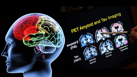 เสี่ยงนะถ้ามีบรรพบุรุษเป็นอัลไซเมอร์