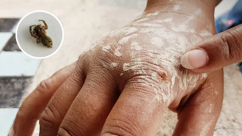 สาวใหญ่ถูกแมงมุมกัด เป็นแผลบวมไหม้ ปวดตามข้อทั่วร่างกาย