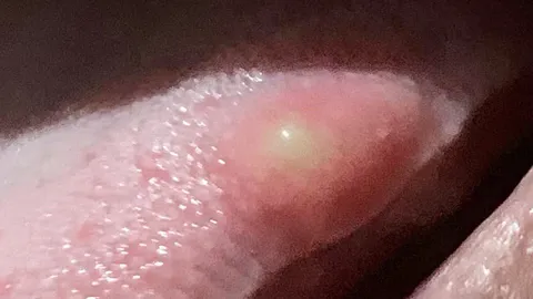 กินผักดิบอย่าชะล่าใจ สาวผงะ "ตัวอ่อนพยาธิตืดหมู" ฝังในลิ้น คล้ายหัวสิว