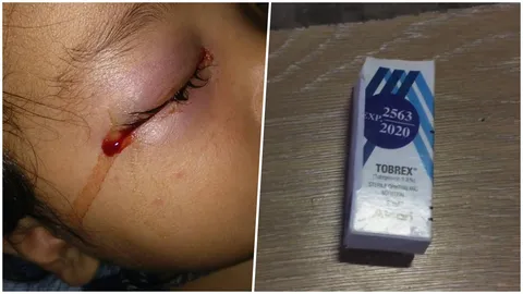 แม่โวย หมอชุ่ยจ่ายยาหยอดตาผิดให้ลูกสาววัย 10 เดือน ทำเลือดออกตา