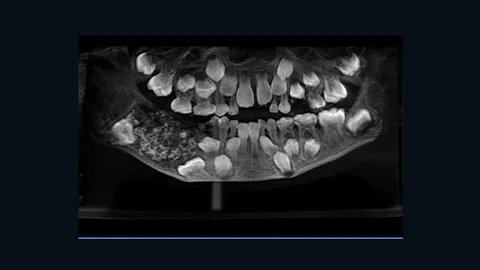 เด็กอินเดียบ่นปวดฟัน หาหมอถึงช็อก เจอฟัน 526 ซี่อยู่ในปาก