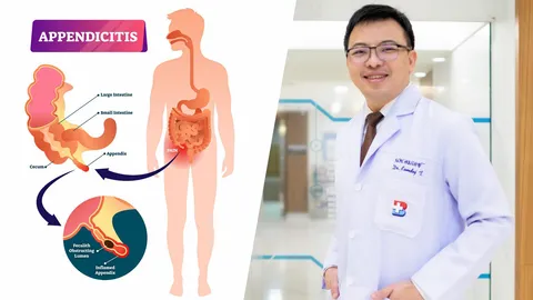 ไส้ติ่งอักเสบเฉียบพลัน เรื่องใหญ่ที่ต้องรู้ให้ไว
