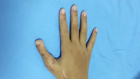 เด็กนิ้วโป้งขาด แพทย์ผ่าตัดเอานิ้วเท้าต่อ กลับมาใช้งานได้ปกติ