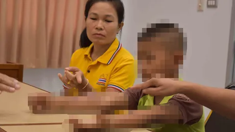 หมอเตรียมผ่าตัดแก้ไขนิ้วมือ เด็กป.4 กาฬสินธุ์ ถูกยางมะตอยราดพรุ่งนี้ 