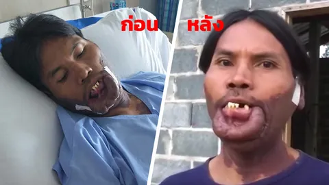 ไขข้อข้องใจ มีมี่ ได้เงินบริจาคหลักแสน เจรจาหมอ ทำศัลยกรรมปาก ทำไมไม่ดีขึ้น