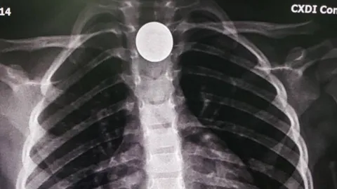 เกือบไปแล้ว 3 ขวบเหรียญติดคอ แพทย์ชี้อันตราย หากสำลักจนอุดกั้นทางเดินหายใจ