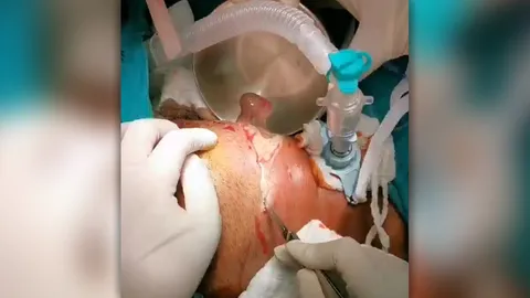 ฟันผุ อย่านิ่งนอนใจ ระวังเป็นฝีหนองใต้คาง ปิดกั้นการหายใจ เสี่ยงตายได้