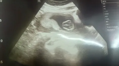 18 ปีที่รอคอย อายุ 43 มีลูก ปาฏิหาริย์รักแท้ ชนะ HIV (คลิป)