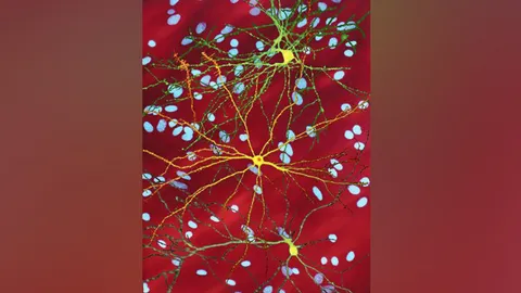 ค้นหาวิธีทำลายเซลล์พิษในโรคฮันติงตัน