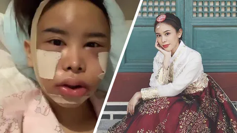 มิ้ง ศวภัทร อัปหน้าใหม่ที่เกาหลี หลังผ่าตัดวันแรกหน้าบวมจำแทบไม่ได้