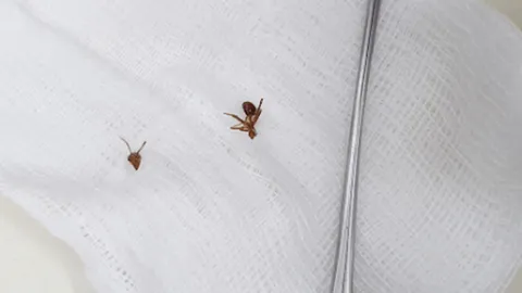 คนไข้นึกว่าก้างปลาติดคอ หมอตรวจละเอียด อึ้ง ที่แท้มดกัดลิ้นไก่