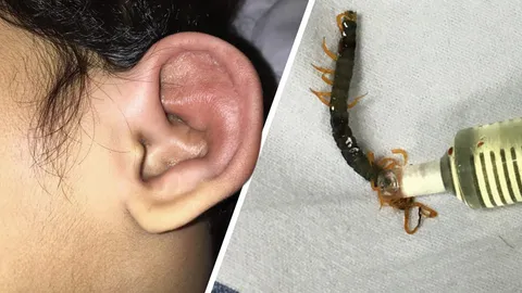 แม่เตือนภัย ตะขาบเข้าหูลูกน้อยกลางดึก เจ็บปวดทรมาน กัดจนบวมแดง