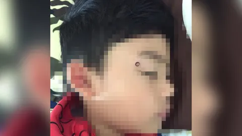 ใจอยู่ที่ตาตุ่ม แม่เตือนภัย ลูกชายล้มพลาดโดน "หลอดสเตนเลส" หวิดทิ่มตา