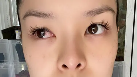 เคลียร์ชัดๆ ฝุ่นนรก PM 2.5 ที่ทำให้ ลีเดีย ตาอักเสบหนักมาก 