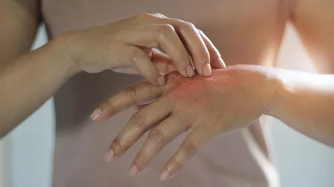 ศุกร์สุขภาพ : “โรคผื่นภูมิแพ้ผิวหนัง” โรคใกล้ตัวที่ไม่ควรมองข้าม
