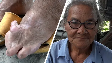 สงสารยายชุบ เนื้องอกเท้าซ้าย เข่าหลุด เร่ขายก๋วยจั๊บ เลี้ยงลูกป่วย