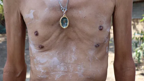 แปลกแต่จริง ลุงวัย 63 ปี มีนม 4 เต้า ติดตลก บอกภูมิใจ มีมากกว่าคนอื่น