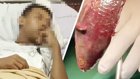 หมอกระบี่ช่วยหนุ่มพม่า คีบปลาหมอที่ติดคอออก หลังอมไว้แล้วดิ้นลงคอ