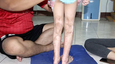 น่าสงสาร ด.ญ. 6 ขวบพลุตกใส่ ผ่าตัดแล้ว 4 ครั้ง แม่จำนำรถรักษาลูก   