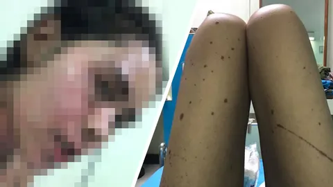 อุทาหรณ์ สาวปวดฟันคุด ซื้อยา "ไอบูโพรเฟน" มากินเองแล้วแพ้หนัก เข้าไอซียู