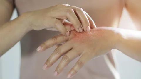 แพทย์เตือนระวัง "โรคไฟลามทุ่ง" โรคผิวหนังที่เกิดจากการติดเชื้อ แนะวิธีป้องกัน