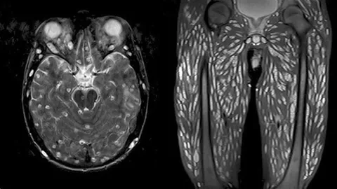 เตือนภัย "ซีสต์พยาธิตืดหมู" เต็มตัวผู้ป่วยวัย 18 หลังปวดหัว อาเจียน ชัก