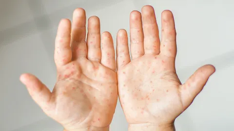 5 โรคสุดฮิต เตือนพ่อแม่ดูแลลูก รับวันเปิดเทอม 1 ก.ค.63