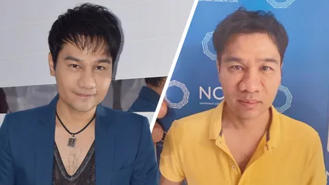 เปิดลิสต์ชัดๆ ใบหน้า กอล์ฟ เบญจพล ก่อน-หลังทำศัลยกรรม ทำอะไรไปบ้าง