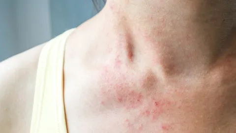 ภูมิแพ้ผิวหนัง แพทย์ชี้เป็นโรคเรื้อรัง ยังไม่มีวิธีรักษาหายขาด แนะวิธีดูแล