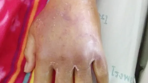 หญิงถูกแมงมุมกัดสาหัส มีโรคแทรกซ้อน ผ่าตัด หัวใจหยุดเต้น ปั๊มช่วย 4 รอบ