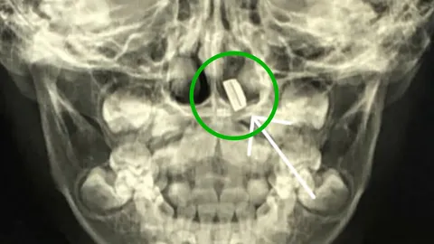 อุทาหรณ์ เด็ก 3 ขวบหายใจติดขัด เอกซเรย์พบ "ถ่านนาฬิกา" หลุดเข้าในจมูก