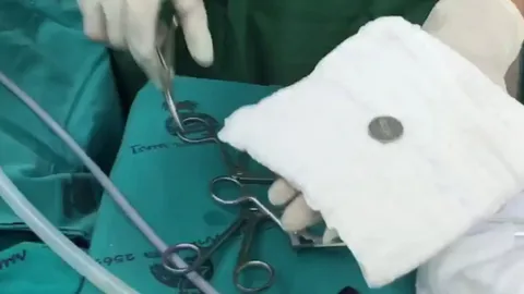 อุทาหรณ์พ่อแม่ สองขวบ กลืนเหรียญลงคอ ค้างหลอดอาหาร อาเจียน น้ำลายฟูมปาก