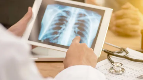 วัณโรคปอด โรคติดต่อใกล้ตัวพบได้บ่อย คร่าชีวิต "โรเบิร์ต" แนะวิธีเช็กอาการป่วย