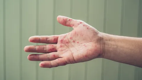 โรคมือ เท้า ปาก ยังไม่มีวัคซีนป้องกัน อาการไม่รุนแรง สามารถหายเองได้