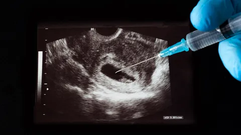 ครม. เห็นชอบแก้กฎหมาย ให้หญิงอายุครรภ์ไม่เกิน 12 สัปดาห์ ทำแท้งได้