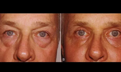 ศัลยกรรมตาวิธีไหน ใช่สำหรับคุณ