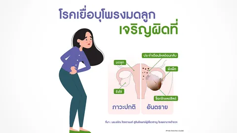 ปวดท้องน้อย อย่าปล่อยผ่าน ภัยเงียบใกล้ตัวผู้หญิงที่ต้องเผชิญ เสี่ยงโรคเยื่อบุโพรงมดลูกเจริญผิดที่