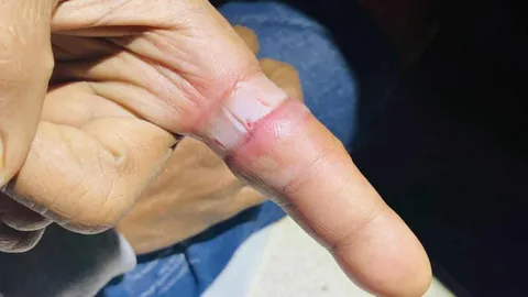 เตือนแหวนติดนิ้ว สวมทั้งๆ ที่คับ สุดท้ายถอดไม่ออก บวมเป่ง ต้องตัดทิ้ง