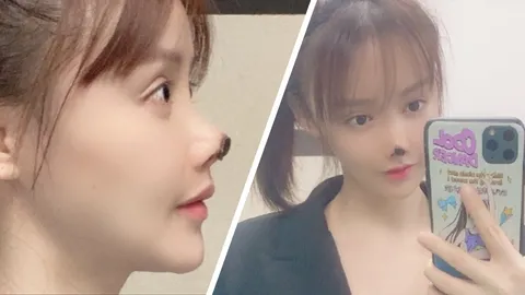 ดาราสาวสวยจีน สุดช็อก เจอ'ฝันร้าย' โชว์จมูกเน่า หลังผ่าตัดศัลยกรรม  