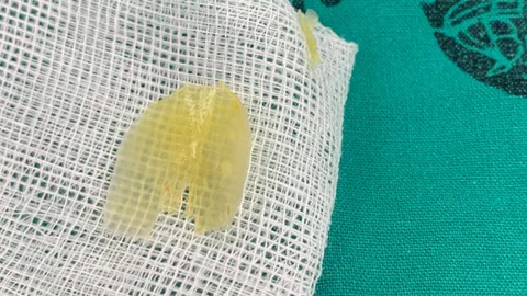 หญิง 60 ปี กินกุ้ง เปลือกแทงติดหลอดอาหาร ปวดรุนแรงต้องหามส่ง รพ.